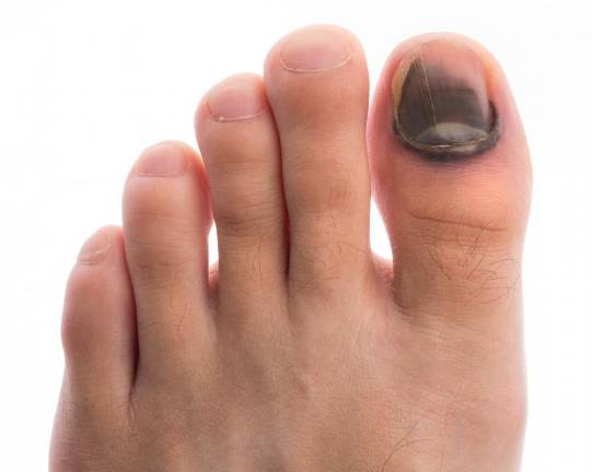 Гематома под ногтем