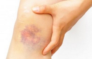 Гематома после введения инъекции Гематома после введения инъекции