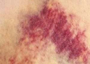 Гематома Гематома