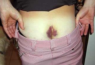 Гематома в области копчика