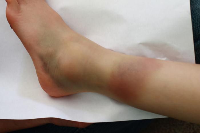 Гематома в области ушиба голеностопа