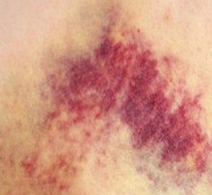 Гематомы при задевании артерий Гематомы при задевании артерий