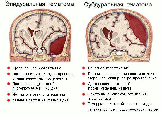Внутричерепные гематомы Внутричерепные гематомы