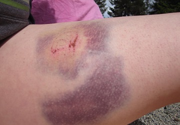 Гематомы и припухлость