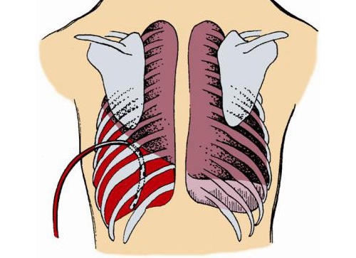 Гемоторакс Гемоторакс
