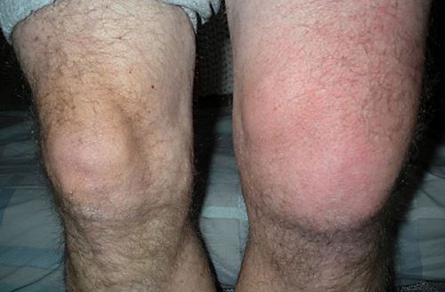 Припухание при гидрартрозе Припухание при гидрартрозе