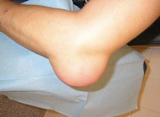 Большая гигрома локтя