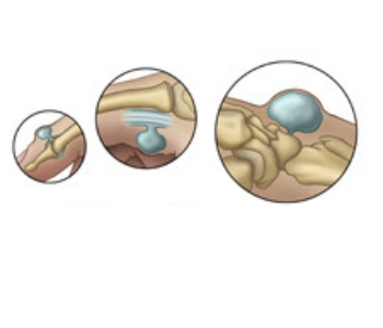 Гигрома мизинца Гигрома мизинца