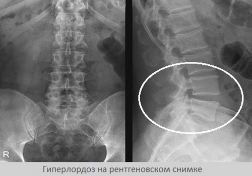 Гиперлордоз на рентген снимке Гиперлордоз на рентген снимке