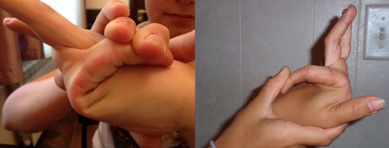 Признаки гипермобильности суставов Признаки гипермобильности суставов