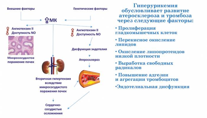 Гиперурикемия Гиперурикемия