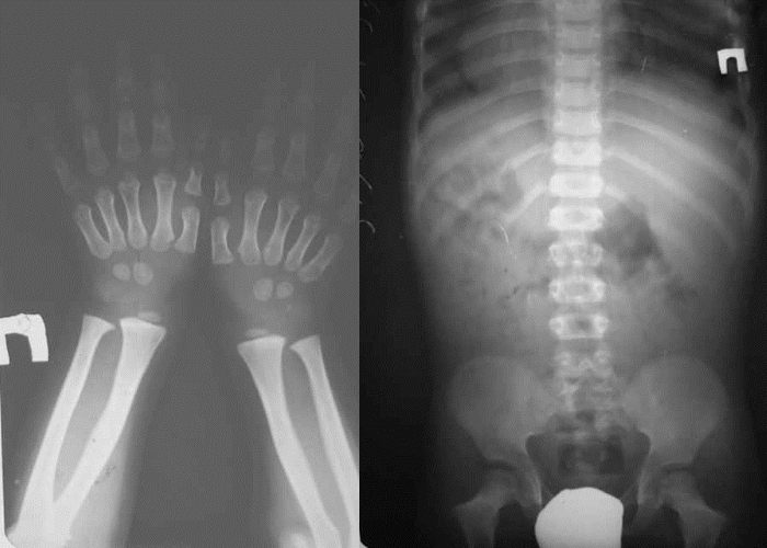 Рентген диагностика гипохондроплазии Рентген диагностика гипохондроплазии