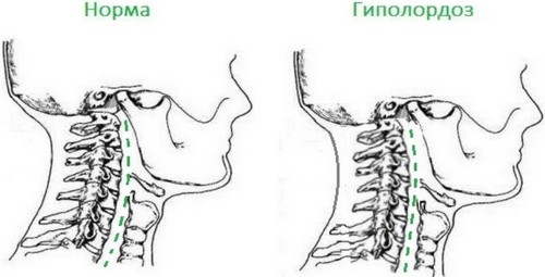Гиполордоз Гиполордоз
