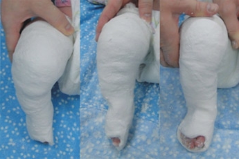 Гипс на колено малыша Гипс на колено малыша