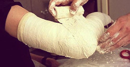 Гипс на локоть