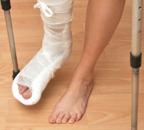 Гипс при переломе стопы