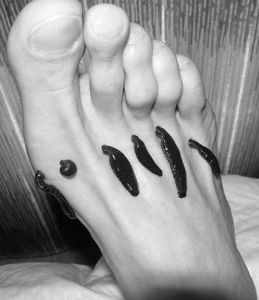 Применение пиявок Применение пиявок