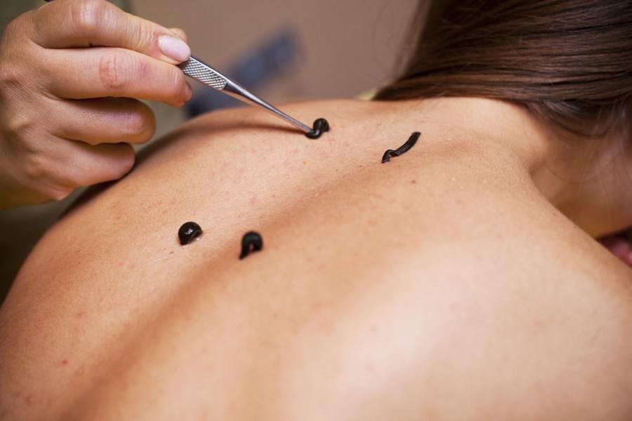 Гирудотерапия при остеохондрозе Гирудотерапия при остеохондрозе