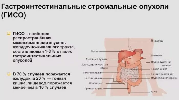 Гастроинтестинальная стромальная опухоль