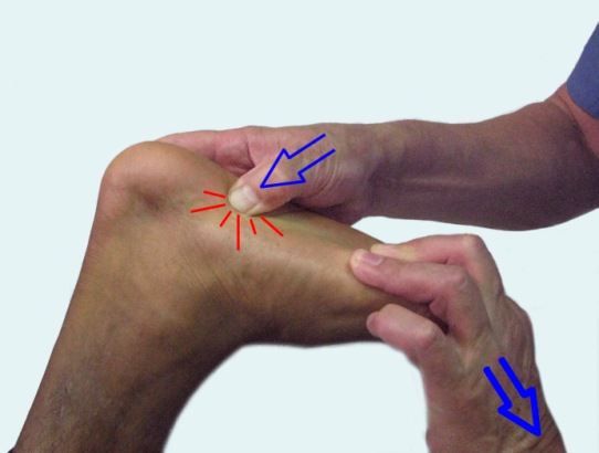Глубокая пальпация плантарной фасции Глубокая пальпация плантарной фасции