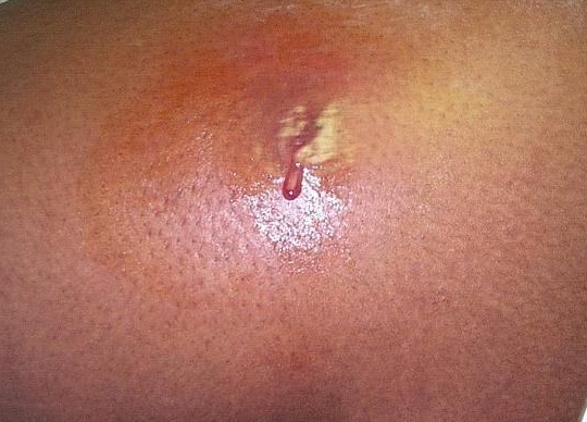 Гнойный миозит Гнойный миозит