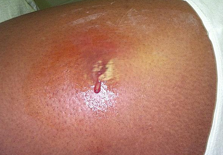 Гнойный воспалительный процесс