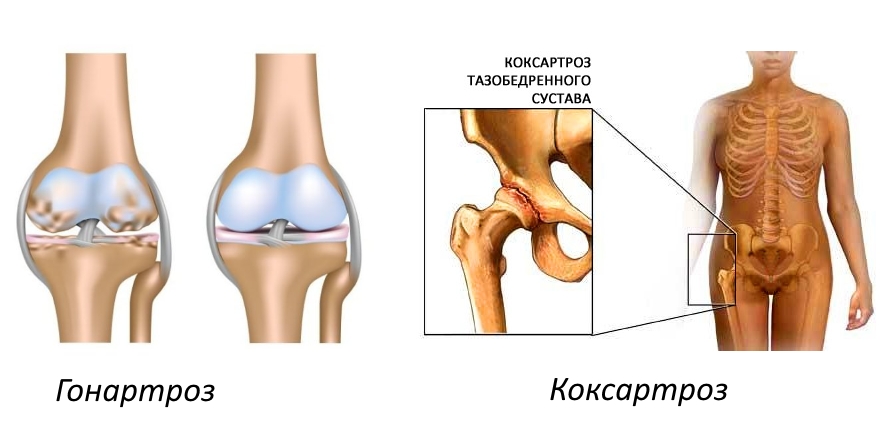 Гонартроз и коксартроз Гонартроз и коксартроз