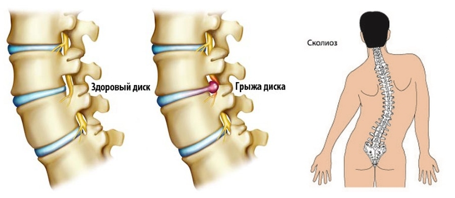 Показания к вертеброревитологии Показания к вертеброревитологии