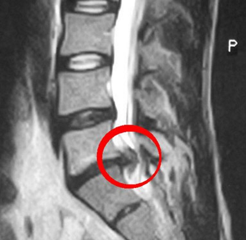 Грыжа позвоночника на рентген снимке Грыжа позвоночника на рентген снимке