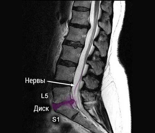 Грыжа дисков L5-S1 на снимке Грыжа дисков L5-S1 на снимке