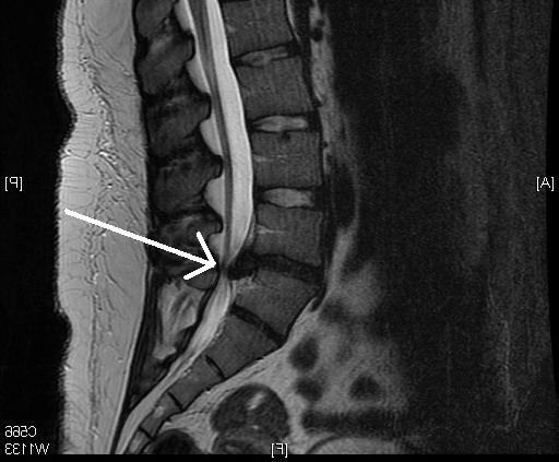 Грыжа и защемление нерва на МРТ Грыжа и защемление нерва на МРТ