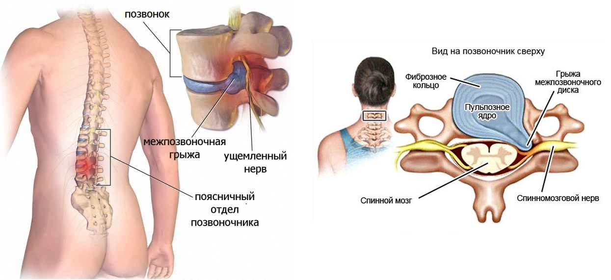 Грыжа поясничного и шейного отделов позвоночника Грыжа поясничного и шейного отделов позвоночника