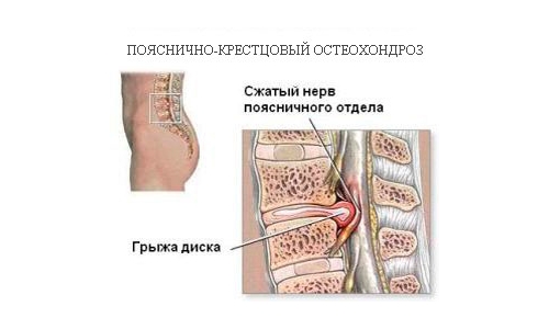 Грыжа поясничного отдела Грыжа поясничного отдела