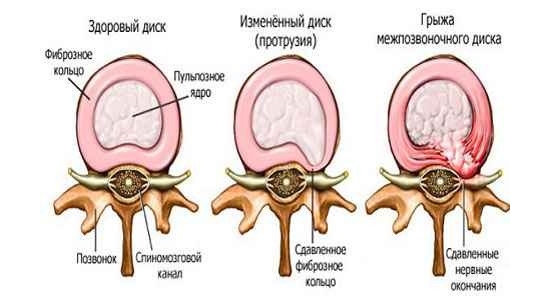 Грыжа позвоночника Грыжа позвоночника