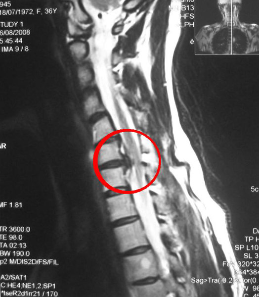 Грыжа позвоночника на рентген снимке Грыжа позвоночника на рентген снимке