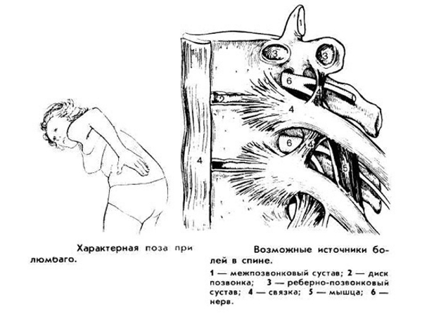 Характерная поза и возможные источники люмбаго Характерная поза и возможные источники люмбаго