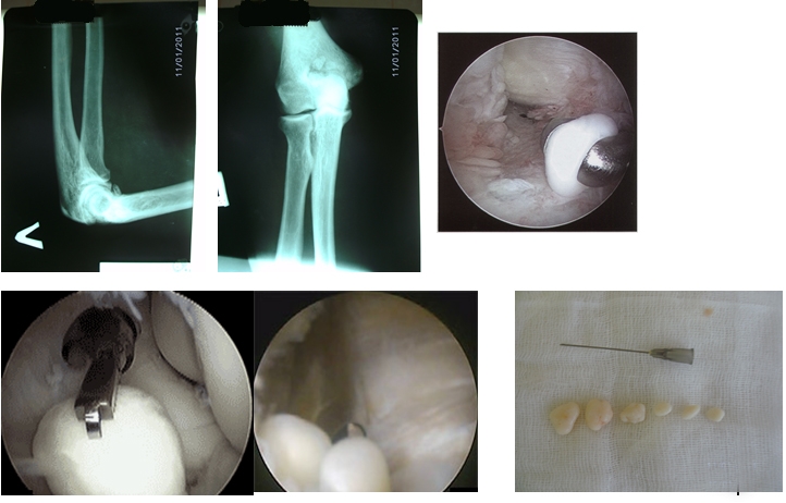 Хирургическое лечение хондроматоза Хирургическое лечение хондроматоза