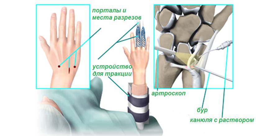Хирургическое лечение синовита кисти Хирургическое лечение синовита кисти