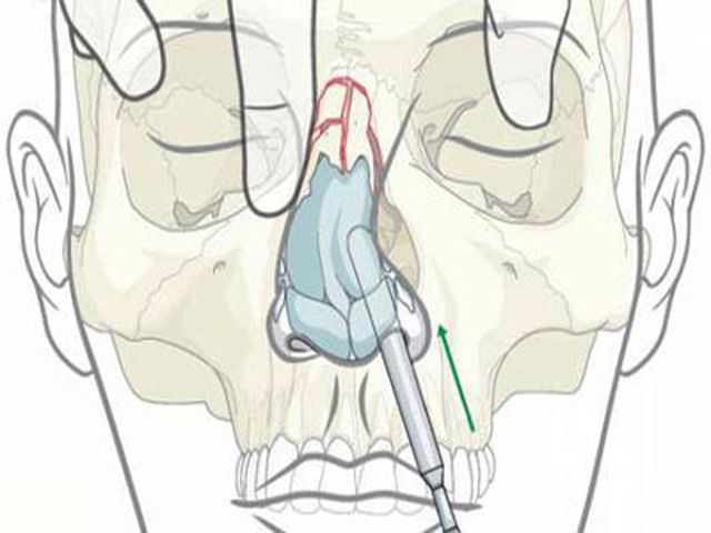 Хирургическое вправление носа Хирургическое вправление носа
