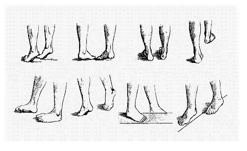 Ходьба при плоскостопии Ходьба при плоскостопии