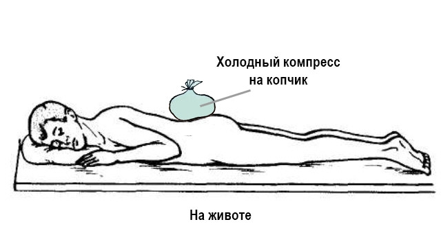 Помощь при вывихе копчика Помощь при вывихе копчика