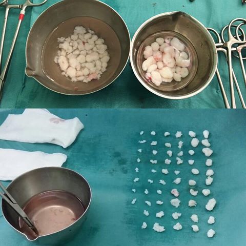 Хондроматозные тела Хондроматозные тела