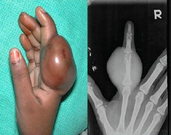 Хондросаркома пальца Хондросаркома пальца