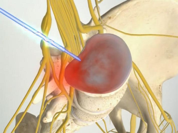 Введение иглы в область нерва грыжи Введение иглы в область нерва грыжи