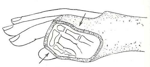 Иммобилизация гипсом Иммобилизация гипсом