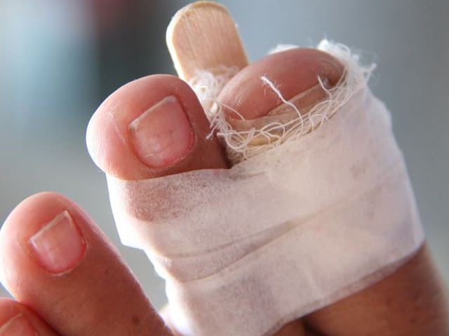 Иммобилизация сломанного пальца на ноге Иммобилизация сломанного пальца на ноге