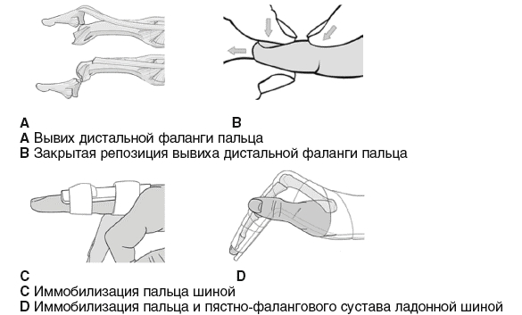 Иммобилизация пальца Иммобилизация пальца
