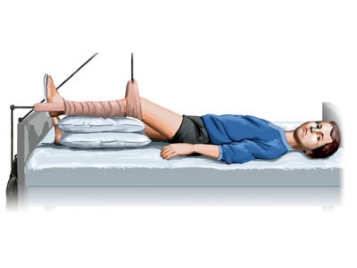 Иммобилизация колена