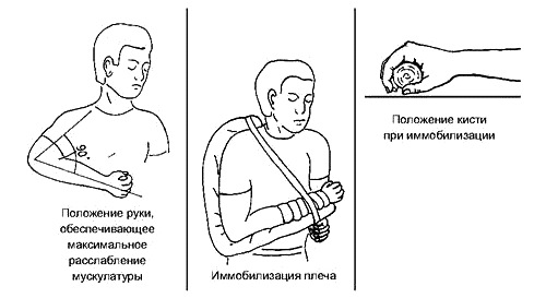 Иммобилизация при переломе предплечья Иммобилизация при переломе предплечья