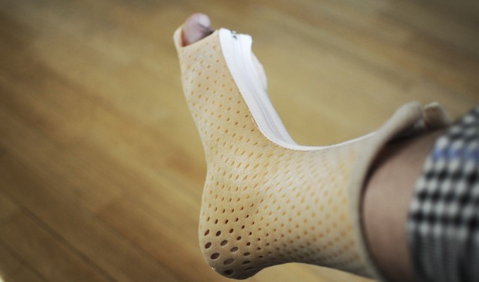 Иммобилизация при переломе костей стопы